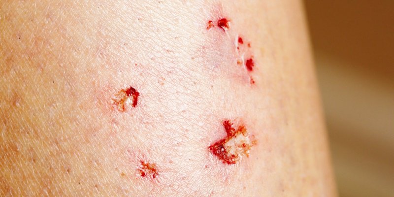 ch&oacute; cắn chảy m&aacute;u